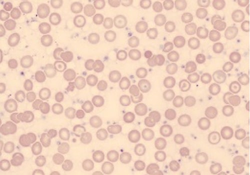 –	Low Hemoglobin Density 